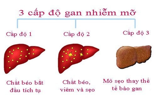 Có cách nào sử dụng trái mướp đắng để trị gan nhiễm mỡ độ 2 không? Nếu có, cách thực hiện như thế nào?
