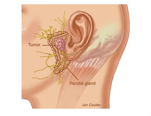 Khái quát về u tuyến nước bọt là lành tính không phải ung thư | BvNTP