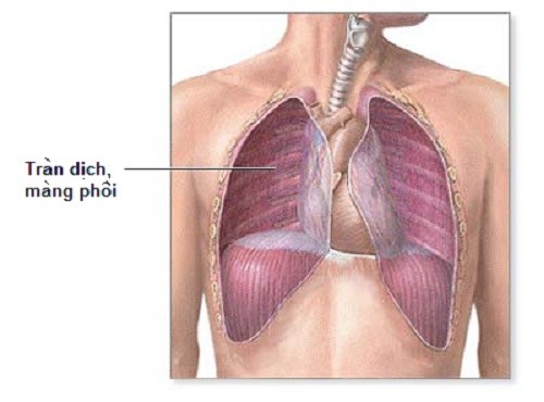 Cách chẩn đoán tràn dịch màng phổi là gì?
