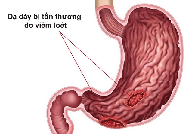 Nguyên nhân viêm loét dạ dày, dấu hiệu nhận biết và điều trị | BvNTP