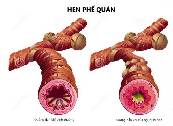 Có những loại thuốc nào khác không nằm trong các nhóm trên mà được sử dụng để điều trị hen suyễn?