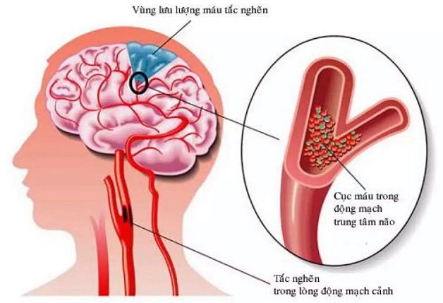 Triệu chứng và cách nhận biết khi mắc bệnh thiếu máu não? 
