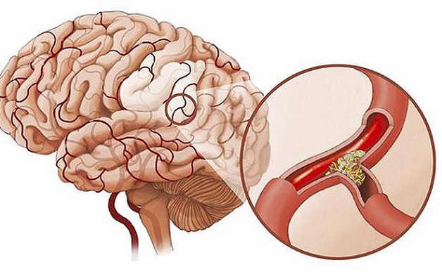 Cách chẩn đoán thiếu máu não là như thế nào?
