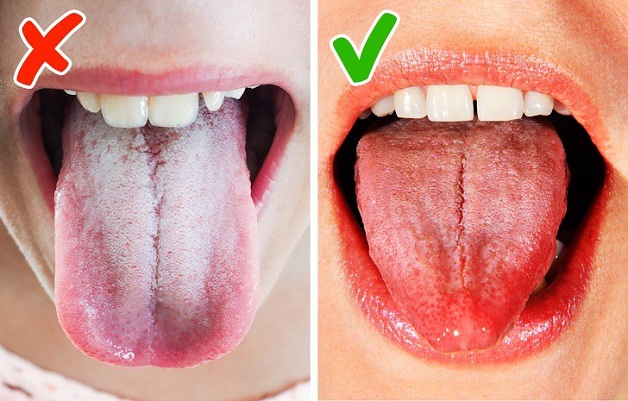Bệnh nấm miệng có liên quan đến lưỡi trắng hay không?
