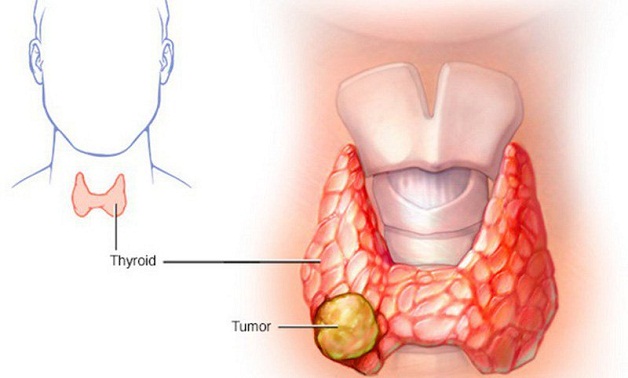 Adenoma tuyến giáp có gây ra vấn đề về chức năng tuyến giáp không?
