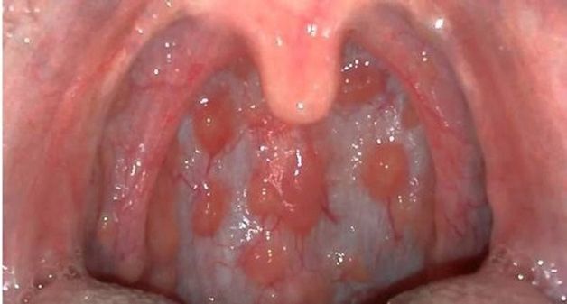 cách chữa viêm họng hạt có mủ