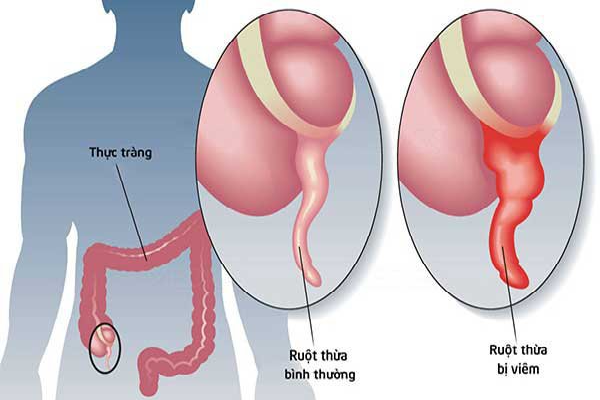 Đau ruột thừa cấp có yêu cầu phẫu thuật ngay lập tức hay có thể điều trị bằng phương pháp khác không?