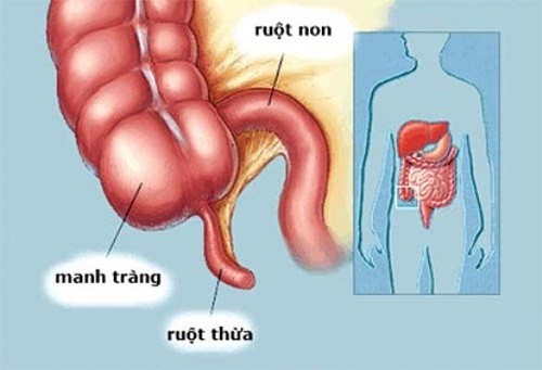 Đau ruột thừa diễn biến như thế nào từ rốn sang vùng bên phải của cơ thể?