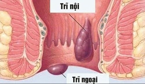 Những hình ảnh về bệnh trĩ ngoại | BvNTP