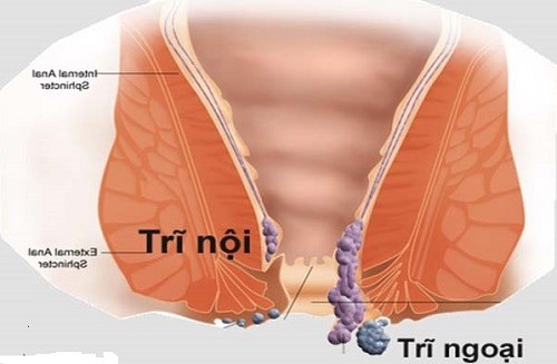 Trĩ nội và trĩ ngoại có những biểu hiện và triệu chứng gì?
