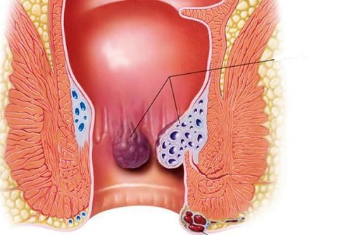 Có những biện pháp nào khác ngoài việc uống thuốc để điều trị polyp hậu môn?
