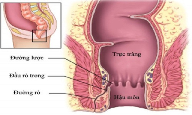 Có những biến chứng nào liên quan đến rò hậu môn?