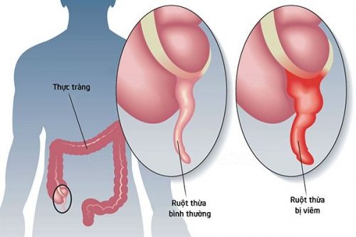 Có cách nào phòng ngừa triệu chứng đau ruột thừa?