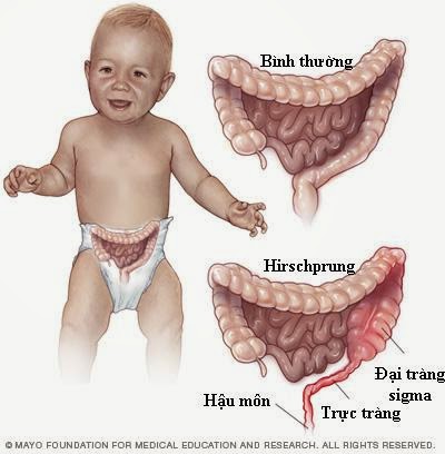 Bệnh dài đại tràng bẩm sinh có thể gây ra những biến chứng nào?
