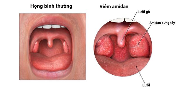 Có cần thực hiện chụp Xquang tim trước khi cắt amidan không?
