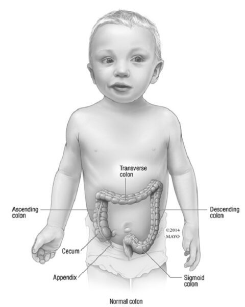 Đau vùng bụng dưới là một triệu chứng đặc trưng của viêm ruột thừa ở trẻ em?
