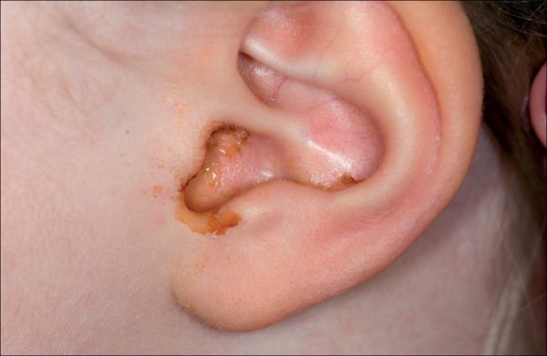 Cách sử dụng thuốc nhỏ viêm tai giữa cho trẻ em như thế nào?

