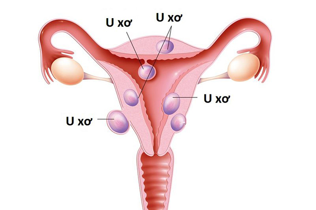 Phương pháp điều trị và quản lý đa nhân xơ tử cung.
