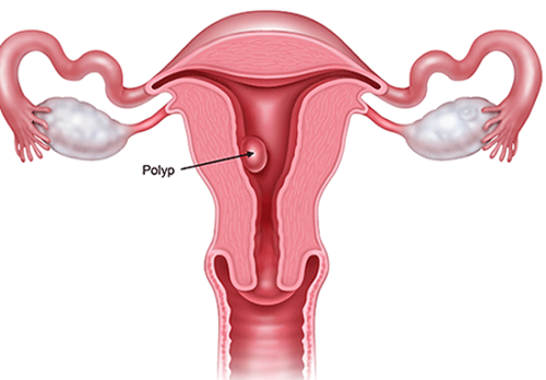 Tác động của polyp tử cung đến thai nhi là gì? 
