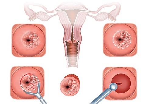 Cách phòng ngừa viêm lộ tuyến sau khi đã điều trị?
