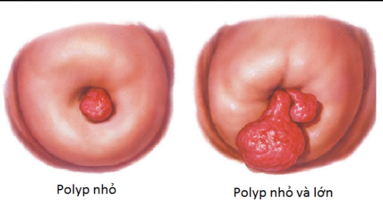 Polyp tử cung có ảnh hưởng đến thai nhi không?
