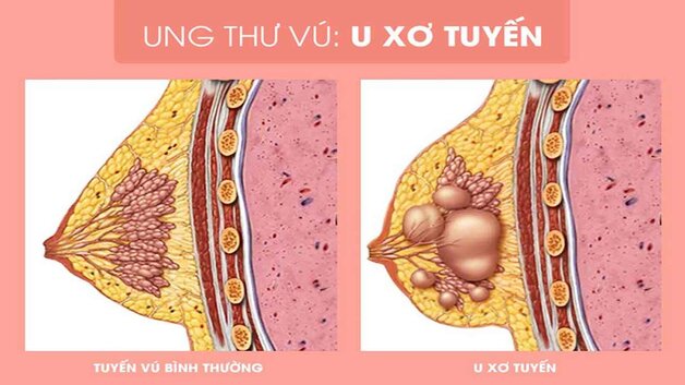 U xơ tuyến vú có thể ảnh hưởng đến việc cho con bú không?
