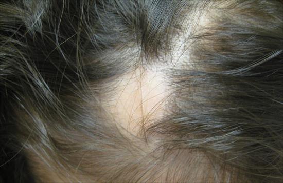 Các đặc điểm soi da của rụng tóc từng mảng là gì