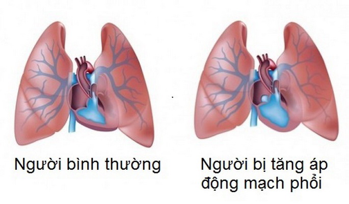 Siêu âm tim 2D & Doppler màu là phương pháp nào được sử dụng để đánh giá tăng áp phổi?
