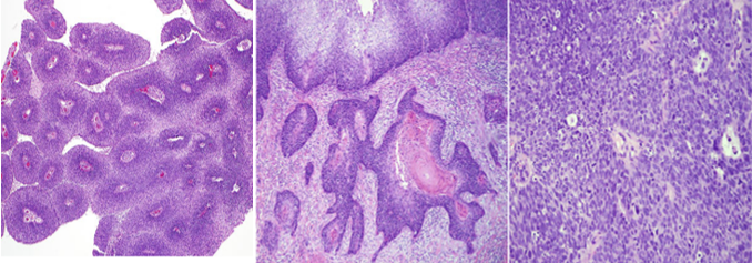 carcinom tế bào gai dạng nhú