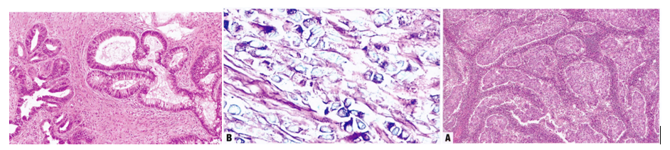 carcinom tuyến tuýp ruột