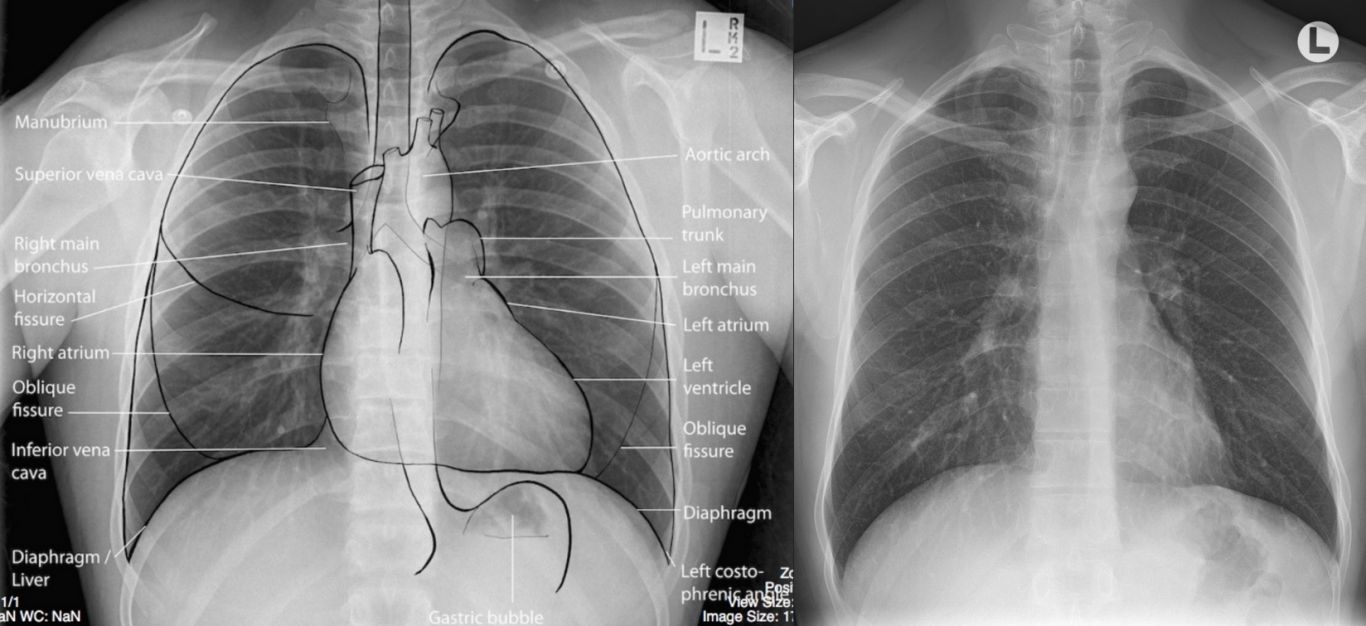 Tác hại chụp  giải phẫu thùy phổi Cần biết những điều này