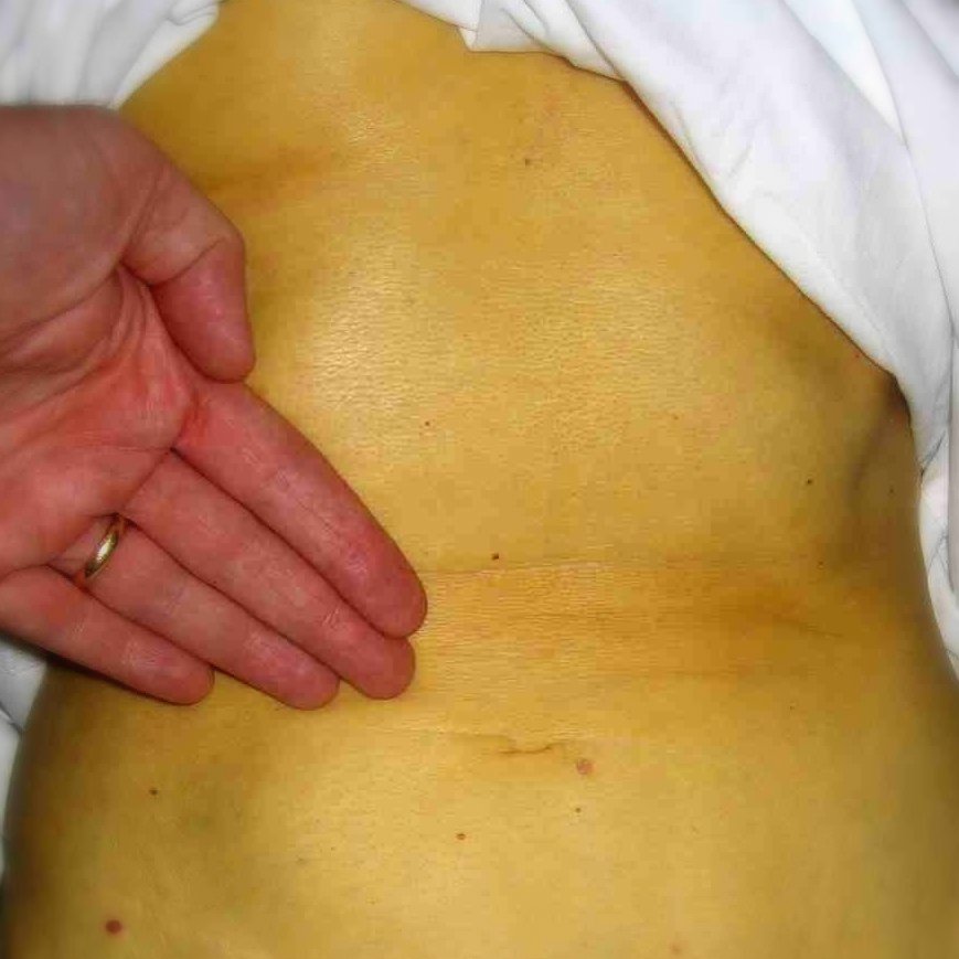 Biểu hiện da trên bệnh nhân bị viêm gan | BvNTP