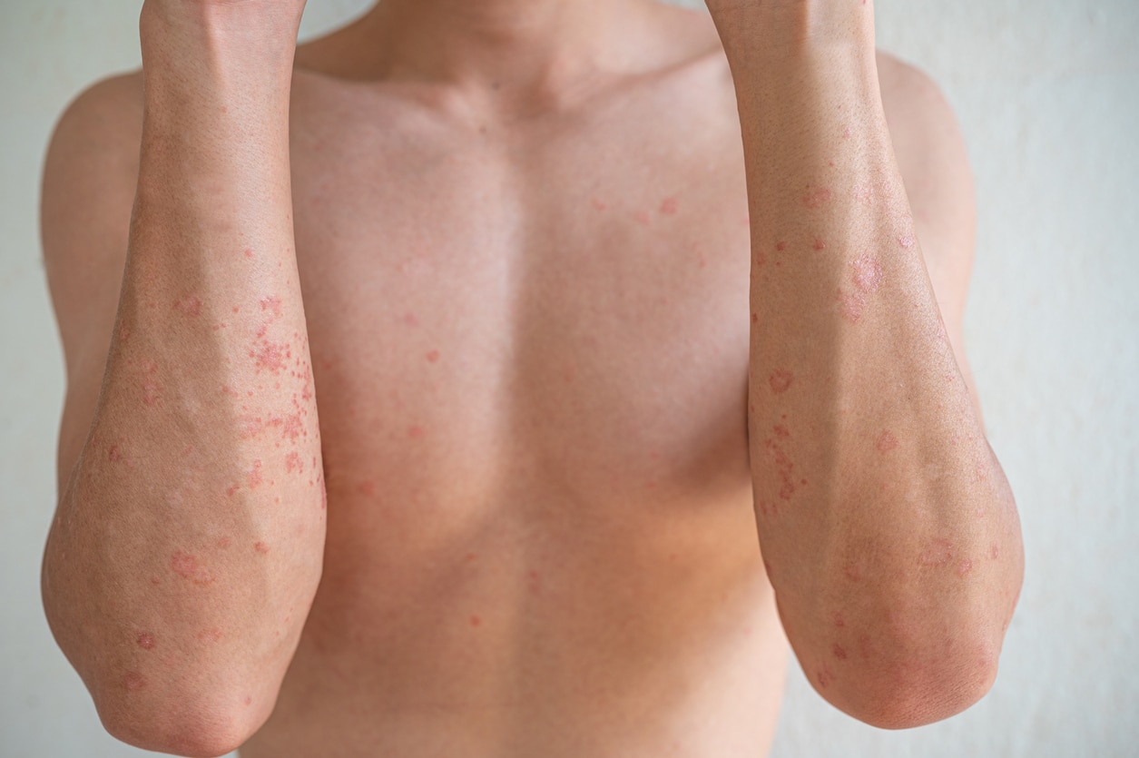 Chàm cơ địa có liên quan đến bệnh da khác không?
