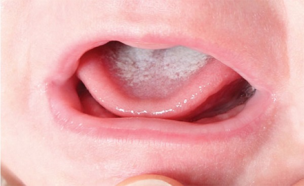 Bệnh nấm lưỡi và cách điều trị | BvNTP