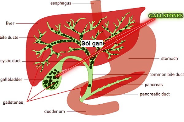 Phương pháp chẩn đoán bệnh sỏi gan là gì?
