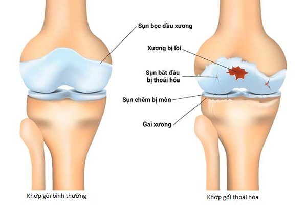 Ai không nên tiêm dịch khớp gối và có những giải pháp thay thế nào?
