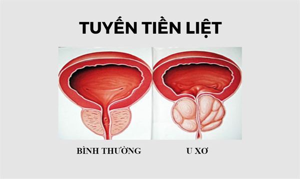 Tại sao biến chứng u xơ tiền liệt tuyến có thể gây nhiễm trùng đường tiết niệu?
