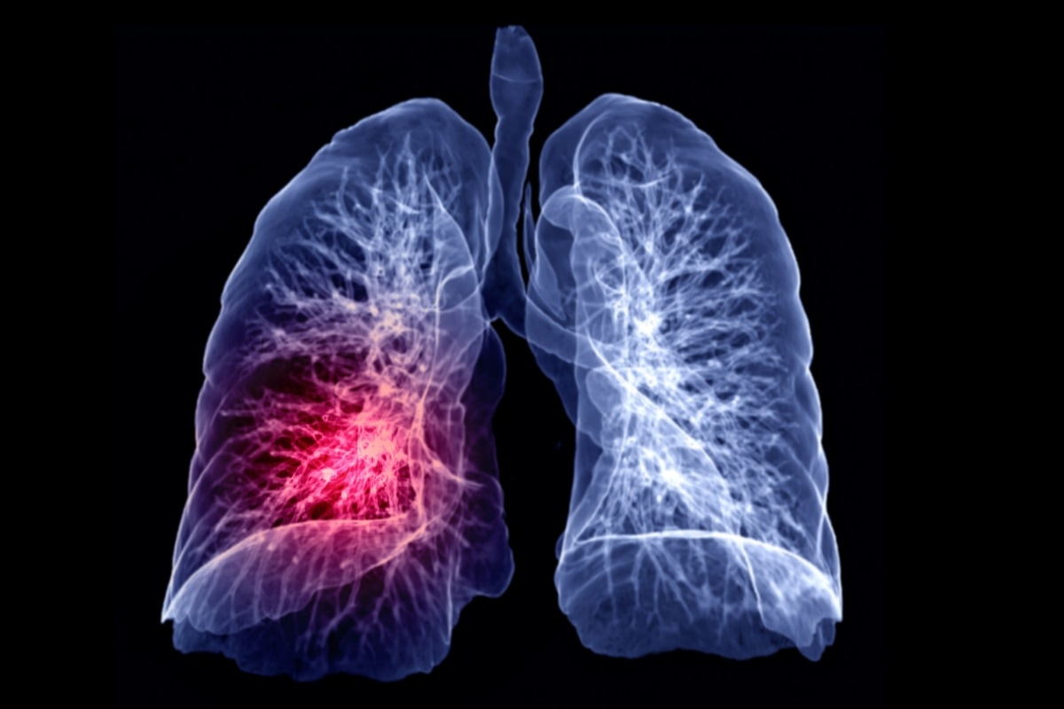 Tác hại chụp  giải phẫu bệnh ung thư phổi Cần biết những điều này