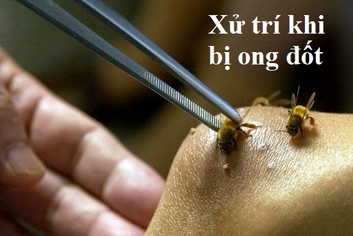 Hướng đẫn chẩn đoán và xử trí khi bị ong đốt | BvNTP