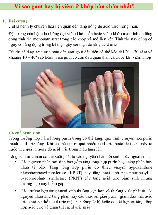 Cách Điều Trị Gout Bàn Chân