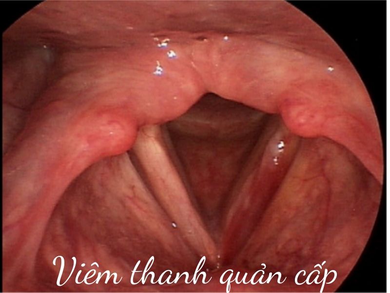 Viêm thanh quản | BvNTP