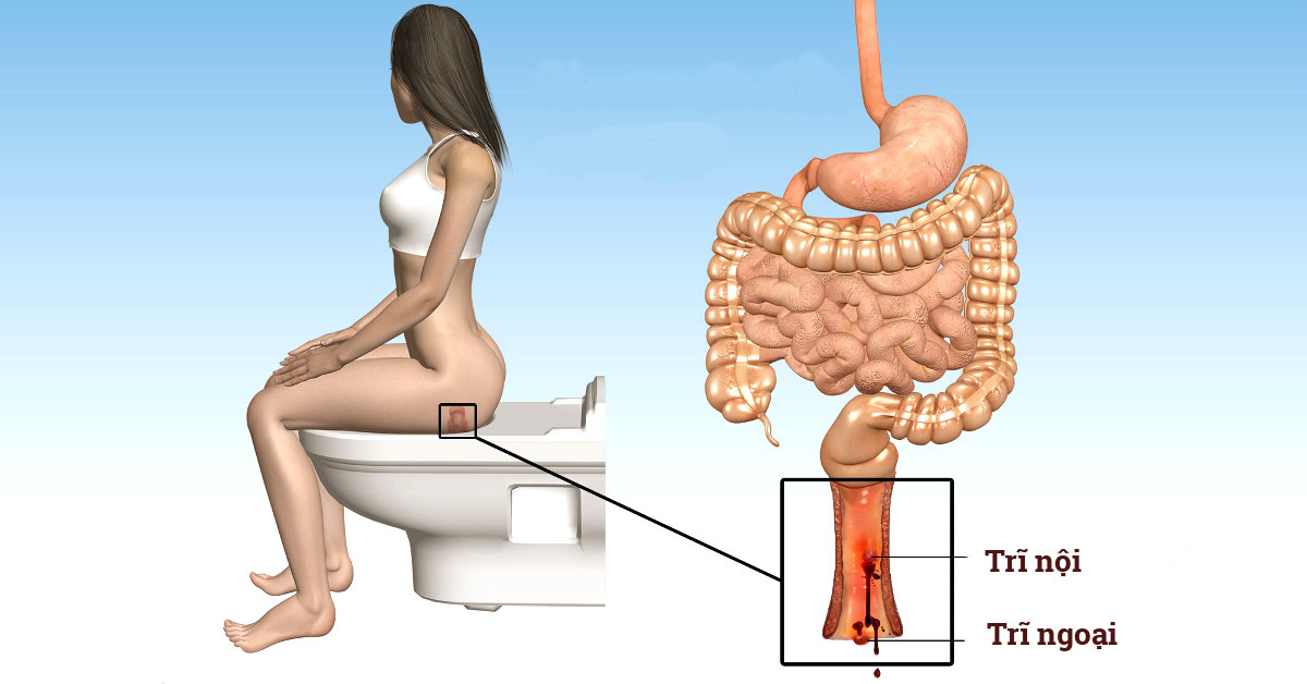 Nắn trĩ là phương pháp điều trị trĩ nội như thế nào?
