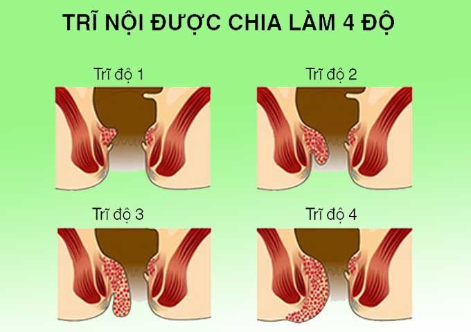 bệnh trĩ nội và dầu hiệu