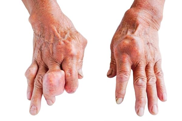 Những triệu chứng của bệnh gout là gì?
