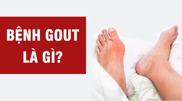 Acid uric máu cần đạt mức bao nhiêu để được chẩn đoán là Gout?
