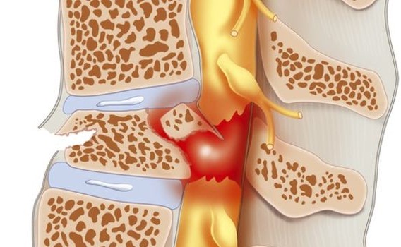 Cách phục hồi chức năng bệnh nhân chấn thương tủy sống hiệu quả và an toàn