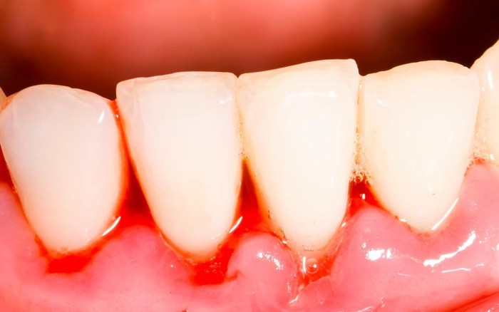 cách điều trị chảy máu nướu răng | BvNTP