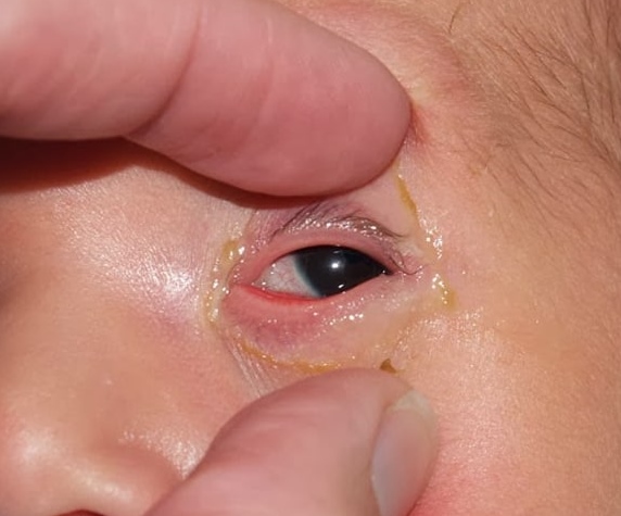 Ghèn mắt ở trẻ sơ sinh | BvNTP