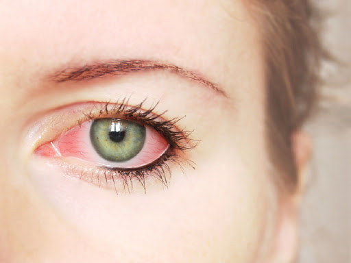 Nguyên nhân chính gây ra chớp mắt đau hốc mắt?
