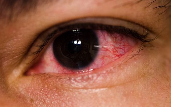 Thuốc tra mắt được sử dụng để điều trị đau mắt đỏ như thế nào?
